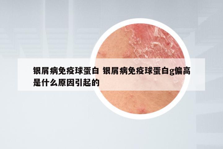 银屑病免疫球蛋白 银屑病免疫球蛋白g偏高是什么原因引起的