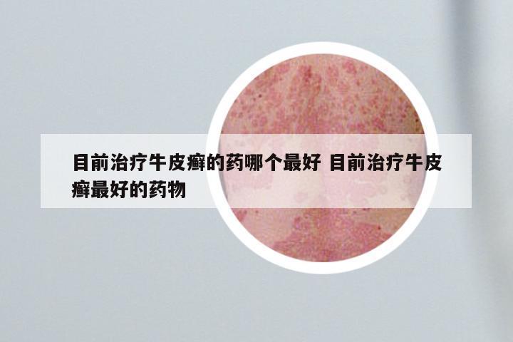 目前治疗牛皮癣的药哪个最好 目前治疗牛皮癣最好的药物