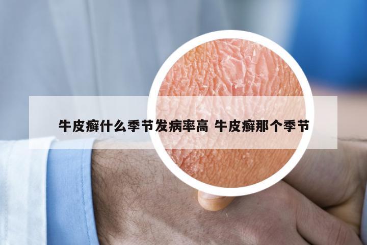 牛皮癣什么季节发病率高 牛皮癣那个季节