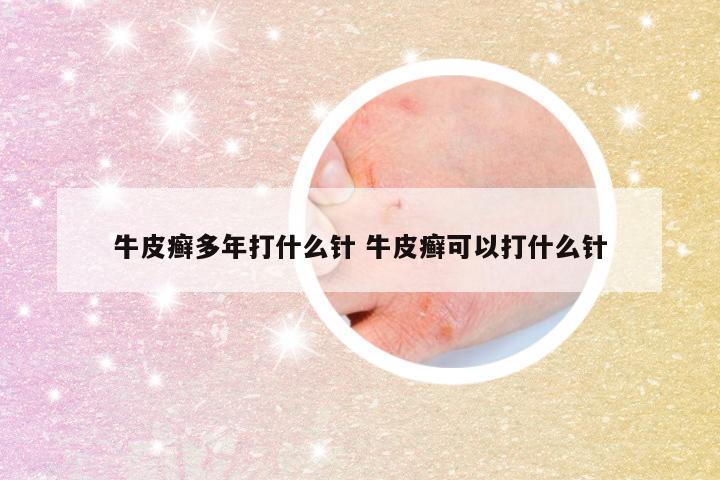 牛皮癣多年打什么针 牛皮癣可以打什么针