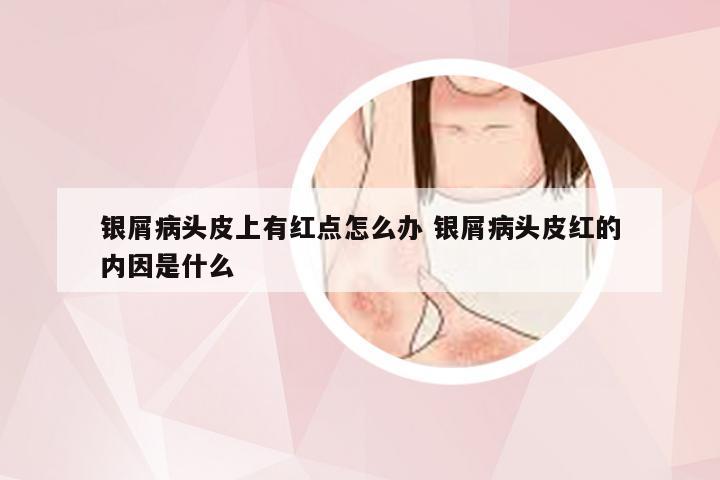 银屑病头皮上有红点怎么办 银屑病头皮红的内因是什么