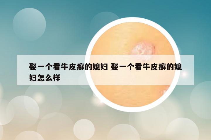 娶一个看牛皮癣的媳妇 娶一个看牛皮癣的媳妇怎么样