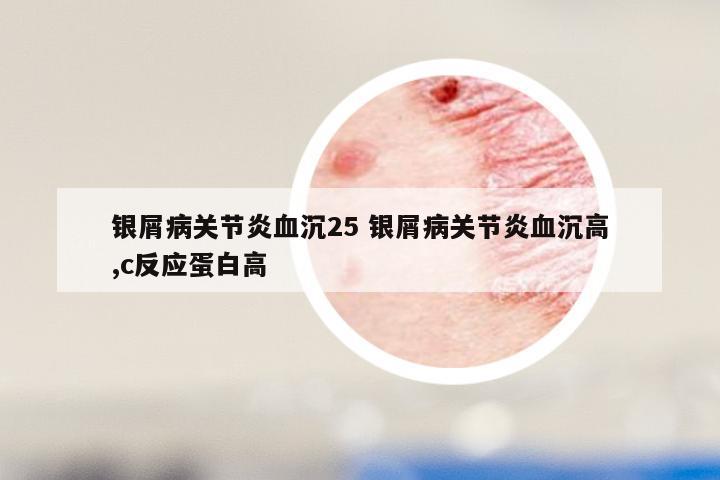 银屑病关节炎血沉25 银屑病关节炎血沉高,c反应蛋白高