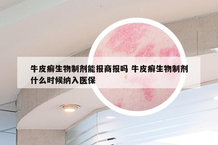 牛皮癣生物制剂能报商报吗 牛皮癣生物制剂什么时候纳入医保