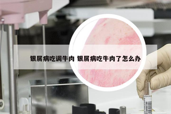 银屑病吃调牛肉 银屑病吃牛肉了怎么办