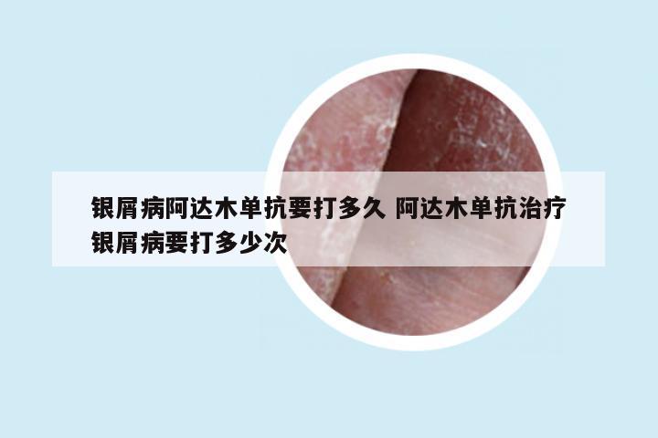 银屑病阿达木单抗要打多久 阿达木单抗治疗银屑病要打多少次