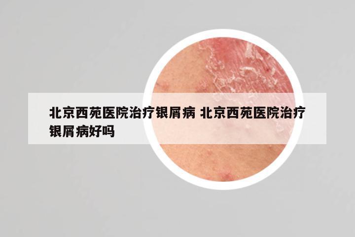 北京西苑医院治疗银屑病 北京西苑医院治疗银屑病好吗