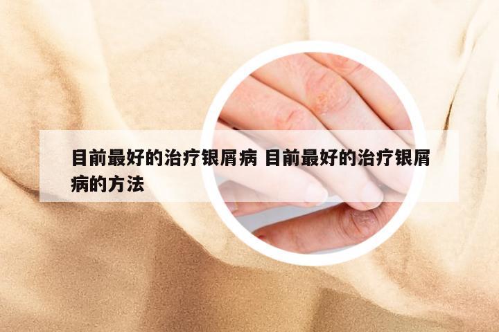 目前最好的治疗银屑病 目前最好的治疗银屑病的方法