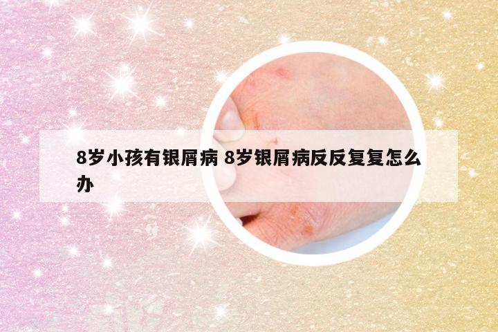 8岁小孩有银屑病 8岁银屑病反反复复怎么办