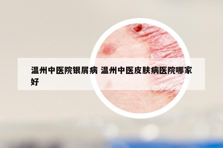 温州中医院银屑病 温州中医皮肤病医院哪家好