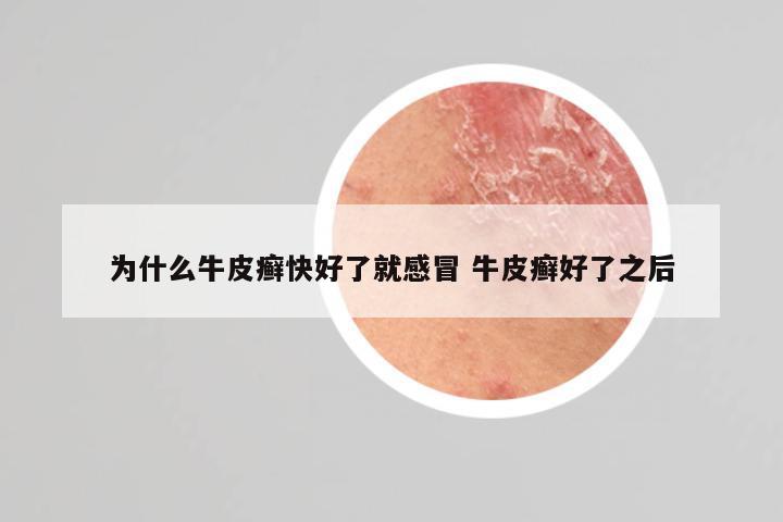 为什么牛皮癣快好了就感冒 牛皮癣好了之后