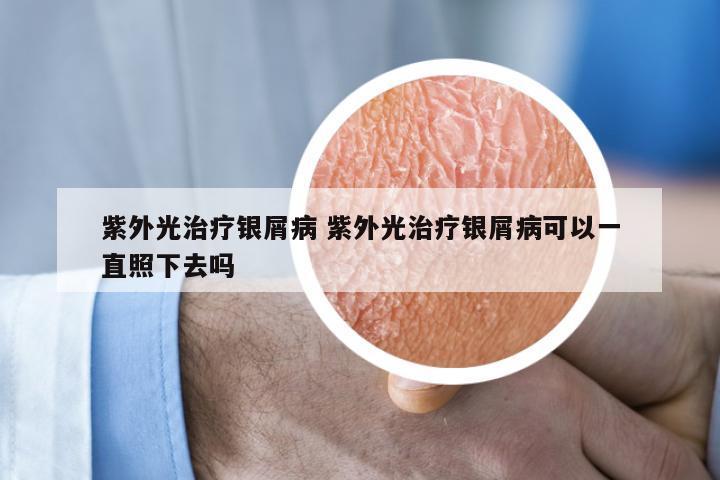 紫外光治疗银屑病 紫外光治疗银屑病可以一直照下去吗
