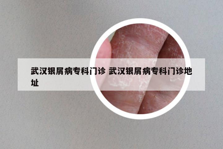 武汉银屑病专科门诊 武汉银屑病专科门诊地址