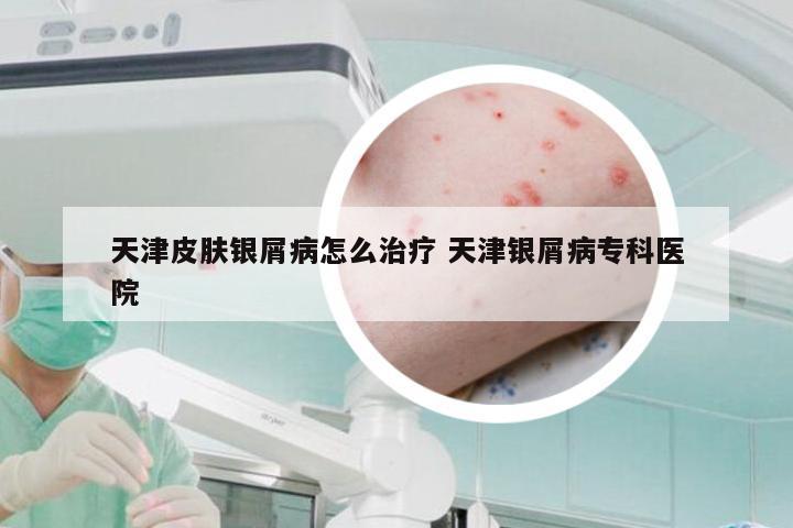 天津皮肤银屑病怎么治疗 天津银屑病专科医院