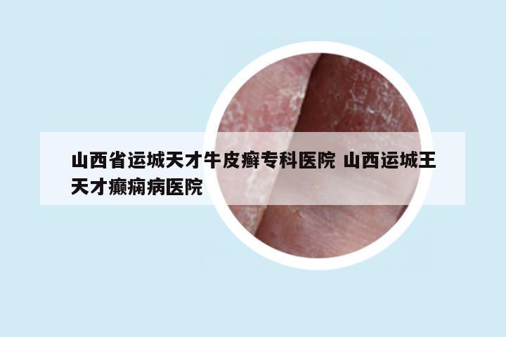 山西省运城天才牛皮癣专科医院 山西运城王天才癫痫病医院