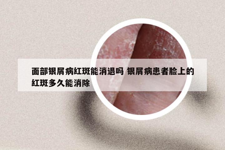 面部银屑病红斑能消退吗 银屑病患者脸上的红斑多久能消除