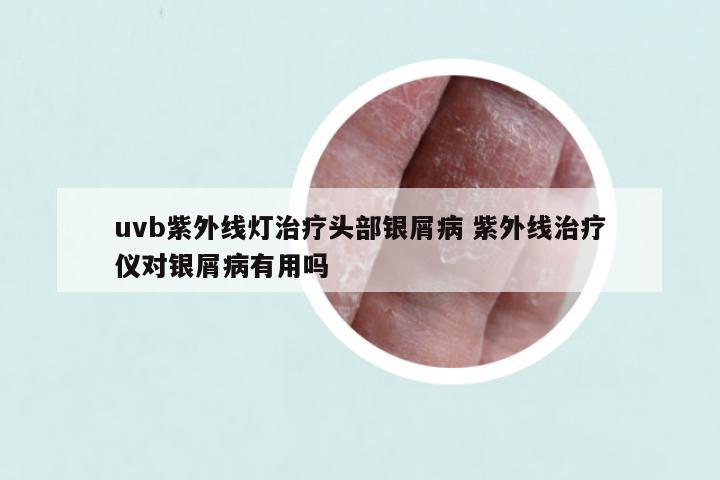 uvb紫外线灯治疗头部银屑病 紫外线治疗仪对银屑病有用吗