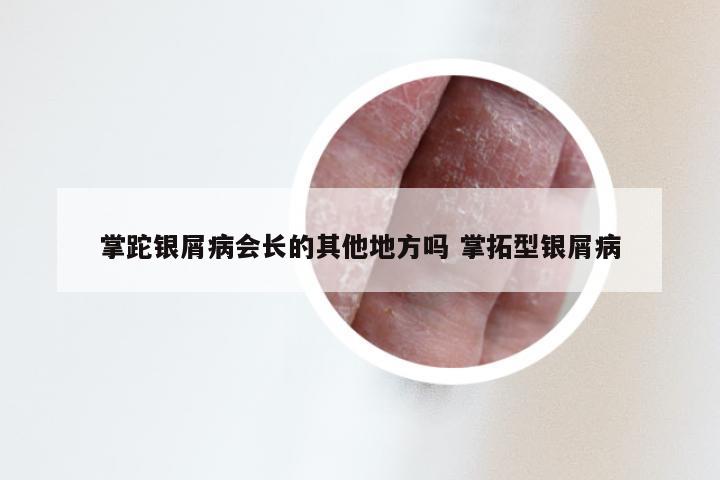 掌跎银屑病会长的其他地方吗 掌拓型银屑病