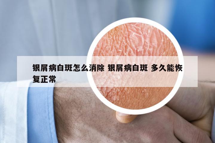 银屑病白斑怎么消除 银屑病白斑 多久能恢复正常