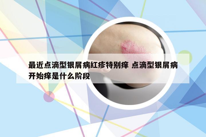 最近点滴型银屑病红疹特别痒 点滴型银屑病开始痒是什么阶段