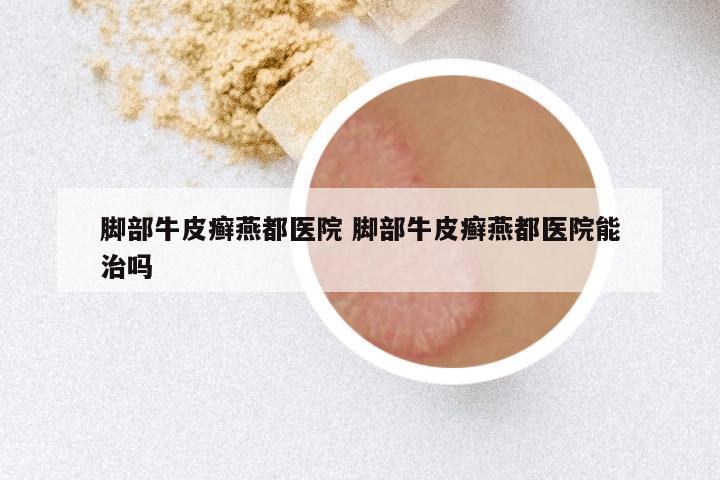 脚部牛皮癣燕都医院 脚部牛皮癣燕都医院能治吗