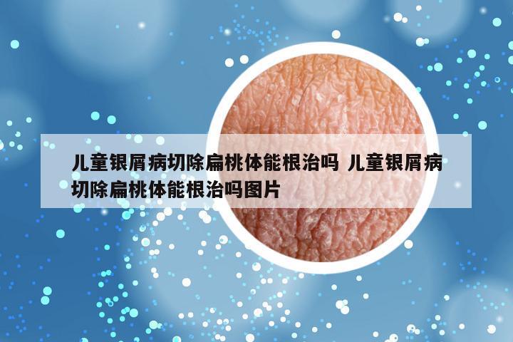 儿童银屑病切除扁桃体能根治吗 儿童银屑病切除扁桃体能根治吗图片