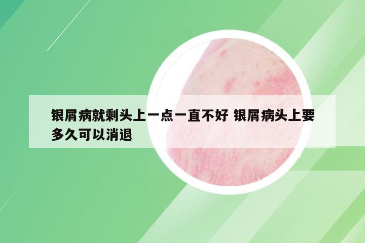 银屑病就剩头上一点一直不好 银屑病头上要多久可以消退