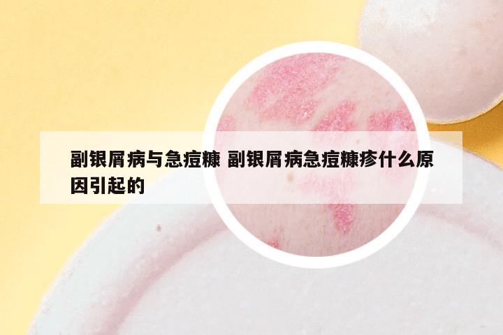 副银屑病与急痘糠 副银屑病急痘糠疹什么原因引起的