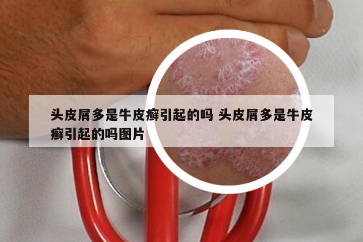 头皮屑多是牛皮癣引起的吗 头皮屑多是牛皮癣引起的吗图片