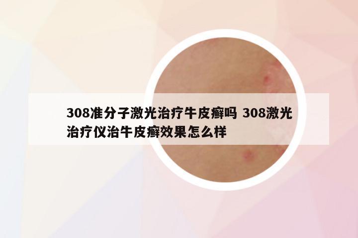 308准分子激光治疗牛皮癣吗 308激光治疗仪治牛皮癣效果怎么样