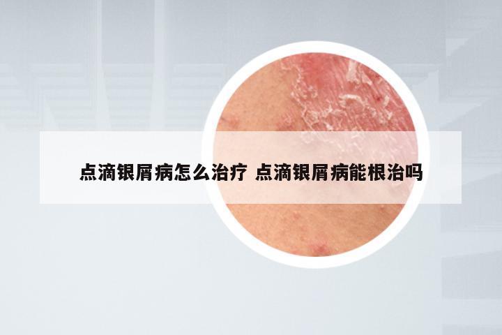 点滴银屑病怎么治疗 点滴银屑病能根治吗