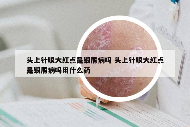头上针眼大红点是银屑病吗 头上针眼大红点是银屑病吗用什么药
