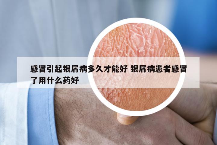 感冒引起银屑病多久才能好 银屑病患者感冒了用什么药好
