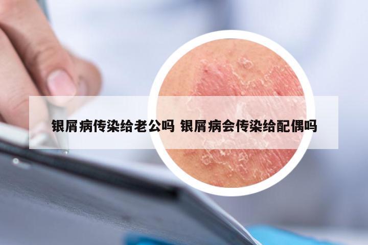 银屑病传染给老公吗 银屑病会传染给配偶吗