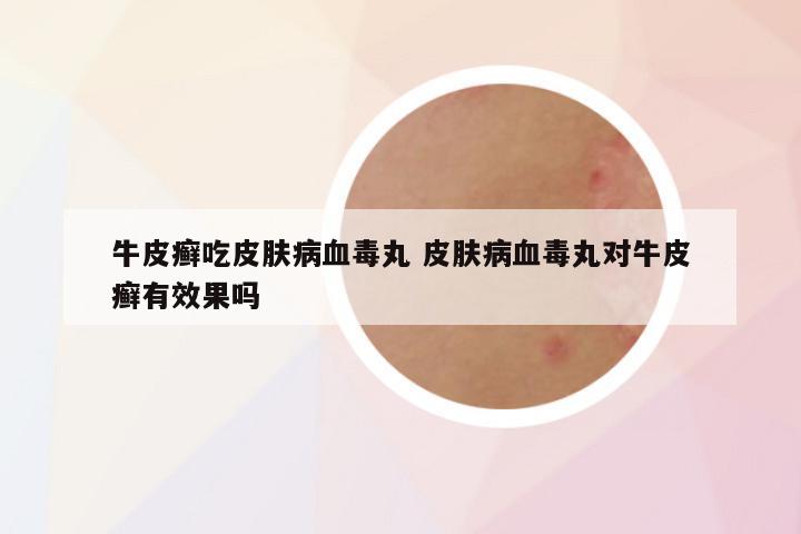 牛皮癣吃皮肤病血毒丸 皮肤病血毒丸对牛皮癣有效果吗