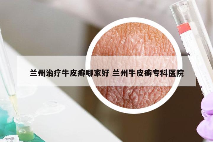 兰州治疗牛皮癣哪家好 兰州牛皮癣专科医院