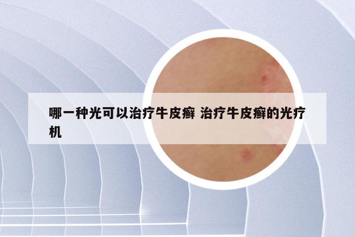 哪一种光可以治疗牛皮癣 治疗牛皮癣的光疗机