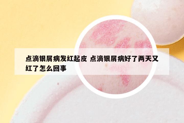点滴银屑病发红起皮 点滴银屑病好了两天又红了怎么回事