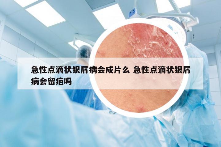 急性点滴状银屑病会成片么 急性点滴状银屑病会留疤吗