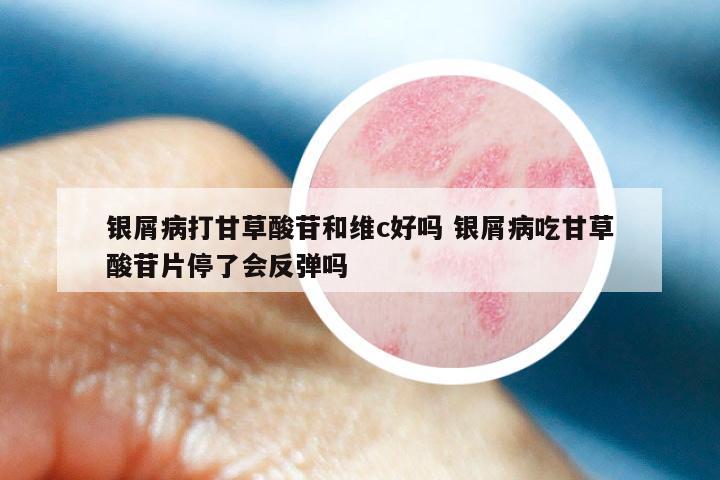 银屑病打甘草酸苷和维c好吗 银屑病吃甘草酸苷片停了会反弹吗