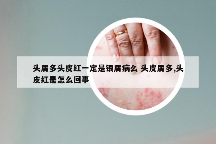头屑多头皮红一定是银屑病么 头皮屑多,头皮红是怎么回事