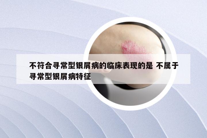 不符合寻常型银屑病的临床表现的是 不属于寻常型银屑病特征