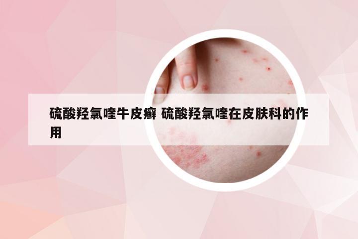 硫酸羟氯喹牛皮癣 硫酸羟氯喹在皮肤科的作用