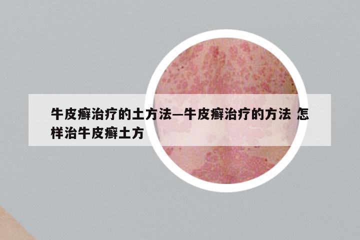 牛皮癣治疗的土方法—牛皮癣治疗的方法 怎样治牛皮癣土方