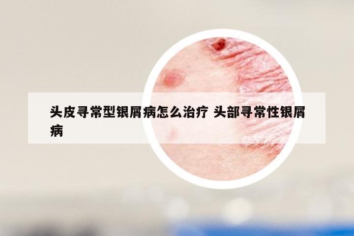 头皮寻常型银屑病怎么治疗 头部寻常性银屑病
