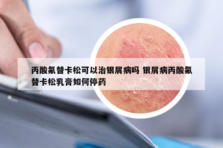丙酸氟替卡松可以治银屑病吗 银屑病丙酸氟替卡松乳膏如何停药