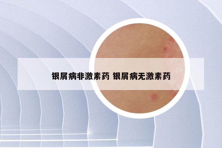 银屑病非激素药 银屑病无激素药
