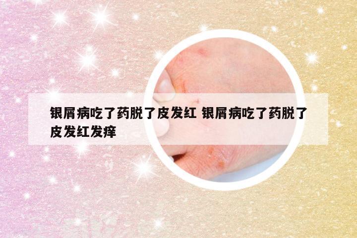银屑病吃了药脱了皮发红 银屑病吃了药脱了皮发红发痒