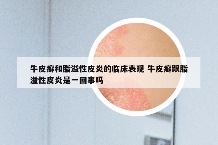 牛皮癣和脂溢性皮炎的临床表现 牛皮癣跟脂溢性皮炎是一回事吗