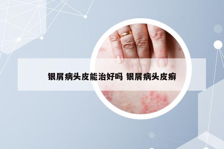 银屑病头皮能治好吗 银屑病头皮癣